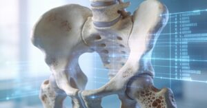 ICD 10 code osteoporosis: A Guide to M81.0 and Fracture Diagnosis